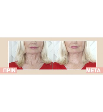 TNS LIFT 60 Body anti-aging system